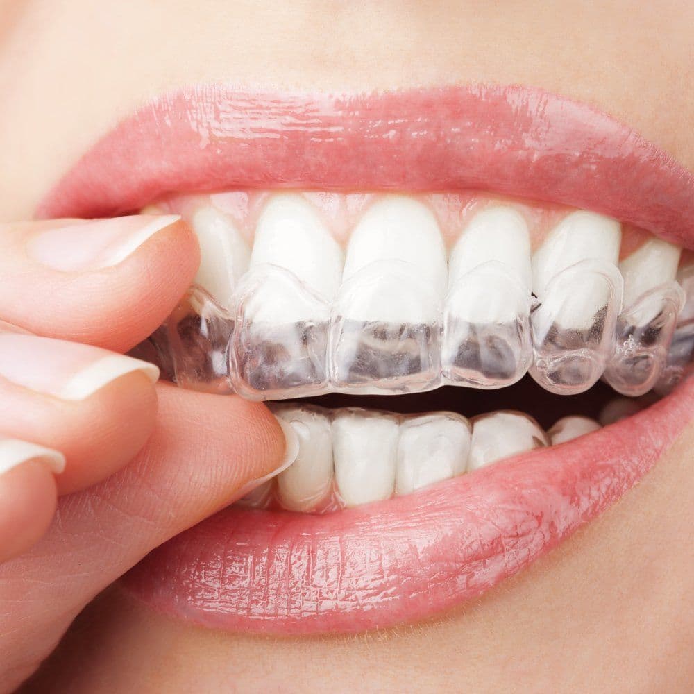 Close-up of a smile with a clear Invisalign aligner being fitted over the upper teeth