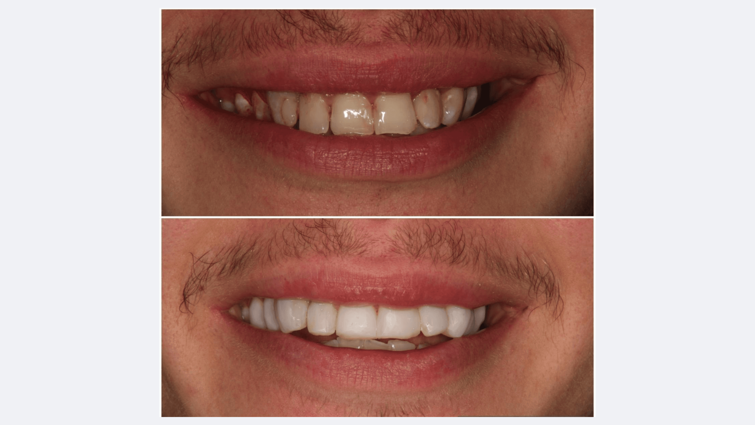 Professional Teeth Whitening London | FAQs at Levitas Dental