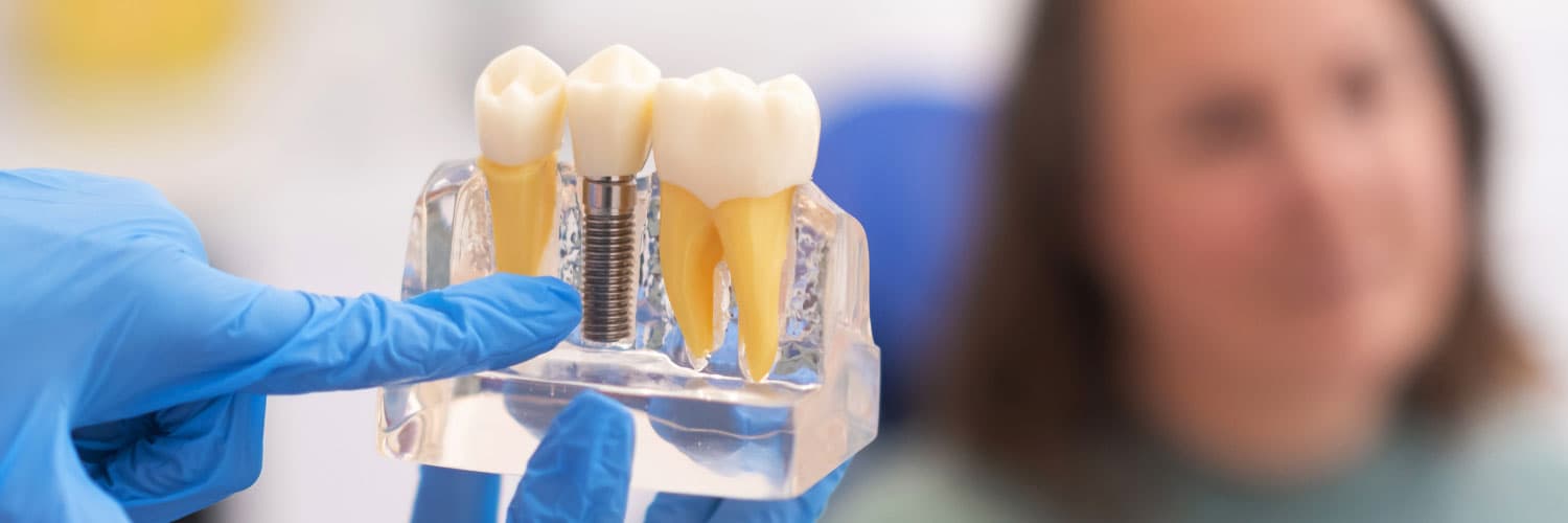 Dental Implants in London: Restore Your Smile with Confidence at Levitas Dental Clinic in Mayfair