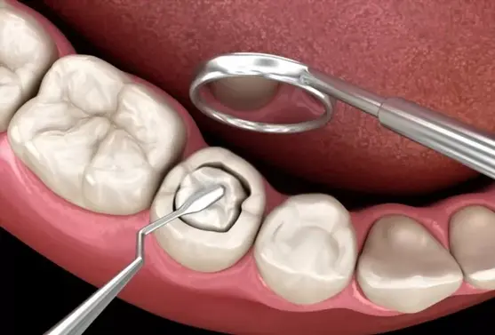 Dental Filling Treatment: Fix Chipped or Broken Teeth